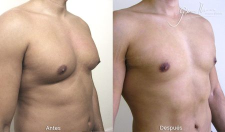 Pezones grandes en hombres: causas y tratamiento recomendado
